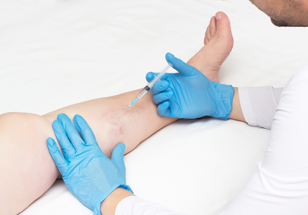 escleroterapia-victorromero